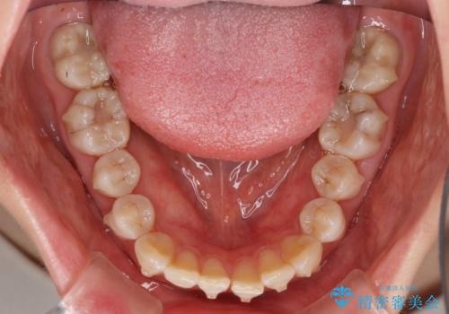 話しにくいオープンバイト インビザラインによる矯正治療の治療中