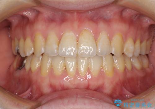 前歯のデコボコを治したい インビザラインによる矯正治療の症例 治療後