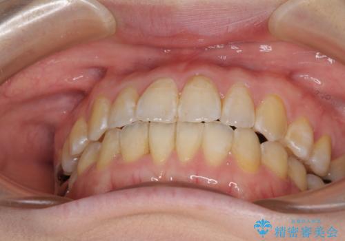 前歯のデコボコを治したい インビザラインによる矯正治療の治療後