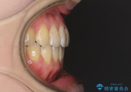 前歯のデコボコを治したい インビザラインによる矯正治療の治療後