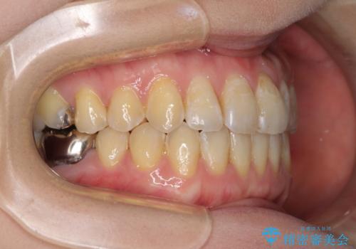 前歯のデコボコを治したい インビザラインによる矯正治療の治療後