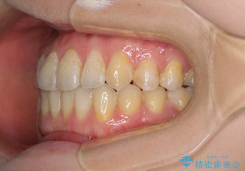 前歯のデコボコを治したい インビザラインによる矯正治療の治療後