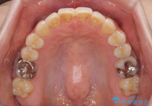 前歯のデコボコを治したい インビザラインによる矯正治療の治療後
