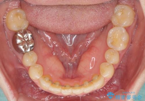 前歯のデコボコを治したい インビザラインによる矯正治療の治療後