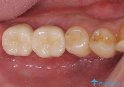 強い咬み合わせで割れてしまった奥歯 インプラントによる咬合回復の症例 治療後