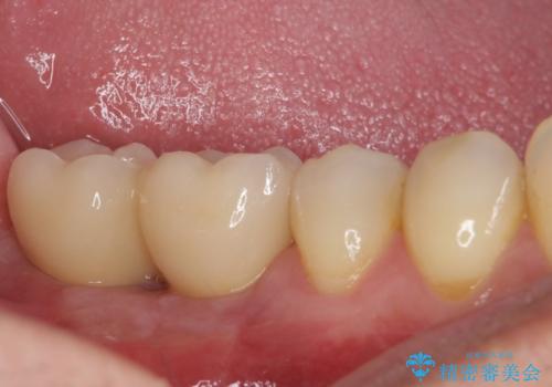 強い咬み合わせで割れてしまった奥歯 インプラントによる咬合回復