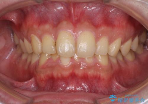 深い咬み合わせと前歯のデコボコの改善　インビザラインによる矯正治療