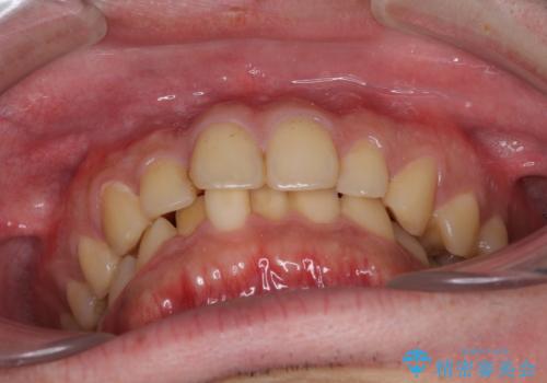深い咬み合わせと前歯のデコボコの改善 インビザラインによる矯正治療の治療前