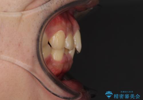 深い咬み合わせと前歯のデコボコの改善 インビザラインによる矯正治療の治療前