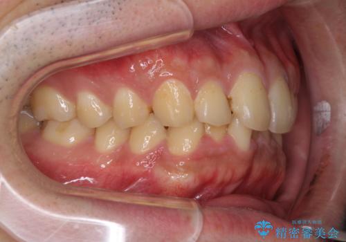 深い咬み合わせと前歯のデコボコの改善 インビザラインによる矯正治療の治療前