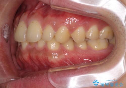 深い咬み合わせと前歯のデコボコの改善 インビザラインによる矯正治療の治療前