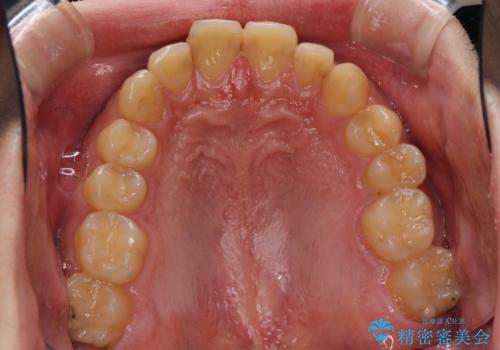 深い咬み合わせと前歯のデコボコの改善 インビザラインによる矯正治療の治療前