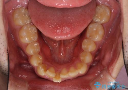 深い咬み合わせと前歯のデコボコの改善　インビザラインによる矯正治療の治療前