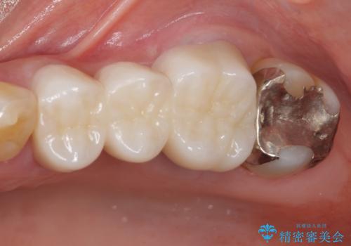 ものが挟まる　奥歯のセラミックブリッジ再製作の症例 治療後