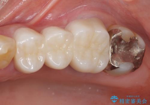 ものが挟まる　奥歯のセラミックブリッジ再製作の治療後
