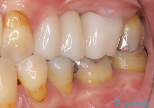 ものが挟まる 奥歯のセラミックブリッジ再製作の治療後