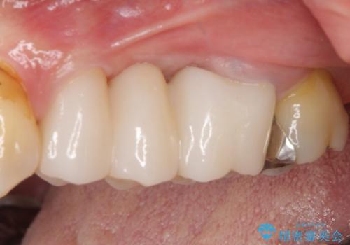 ものが挟まる 奥歯のセラミックブリッジ再製作の治療後