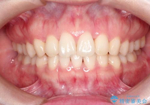 前歯のねじれをきれいにしたい　インビザラインによる見えない矯正治療の治療後