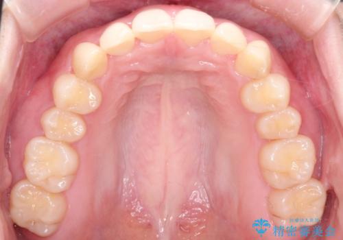 前歯のねじれをきれいにしたい インビザラインによる見えない矯正治療の治療後