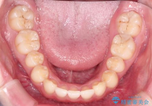 前歯のねじれをきれいにしたい　インビザラインによる見えない矯正治療の治療後