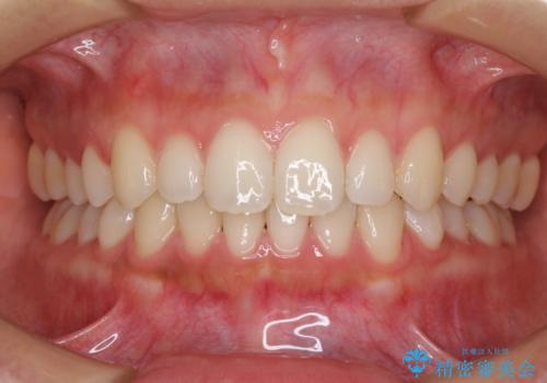 海外勤務中でも矯正治療 インビザラインによる軽度叢生改善