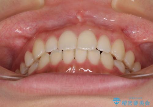 海外勤務中でも矯正治療 インビザラインによる軽度叢生改善の治療後