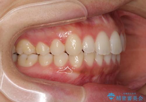 海外勤務中でも矯正治療 インビザラインによる軽度叢生改善の治療後