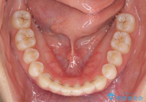 海外勤務中でも矯正治療 インビザラインによる軽度叢生改善の治療後