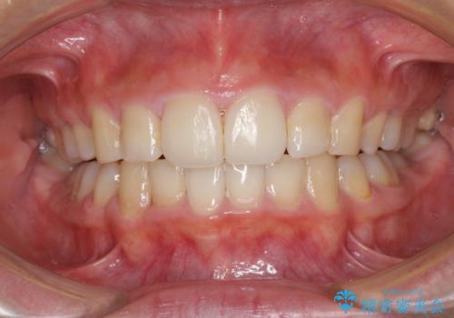 口が閉じられない 抜歯矯正で口元をスッキリとの治療後