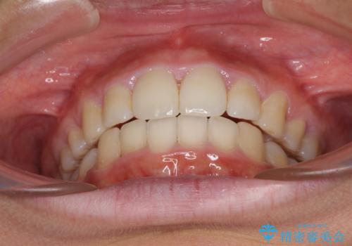 口が閉じられない 抜歯矯正で口元をスッキリとの治療後