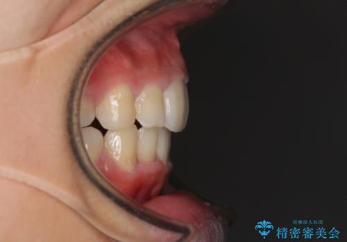 口が閉じられない 抜歯矯正で口元をスッキリとの治療後