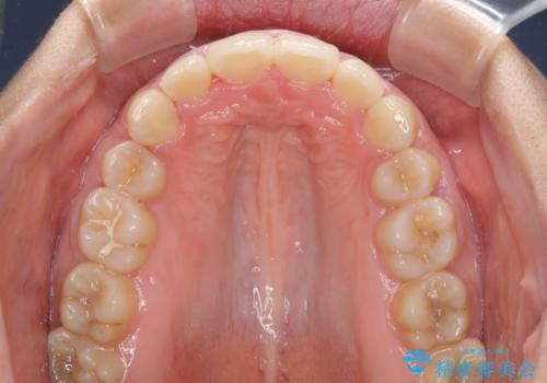 口が閉じられない 抜歯矯正で口元をスッキリとの治療後