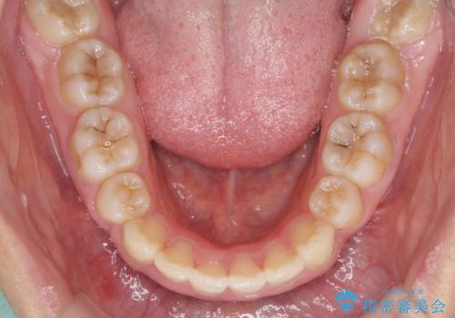 口が閉じられない 抜歯矯正で口元をスッキリとの治療後