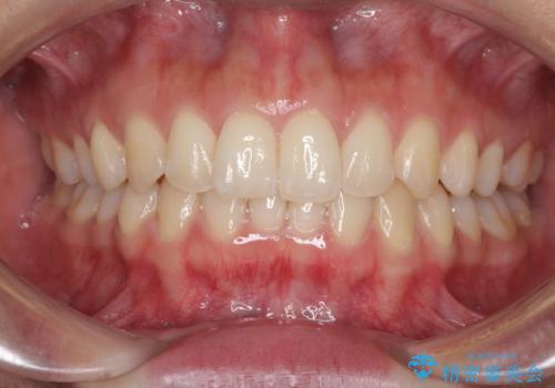 ディープバイトと前歯のデコボコを治したい インビザラインによる矯正治療の治療中