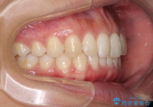 ディープバイトと前歯のデコボコを治したい インビザラインによる矯正治療の治療中