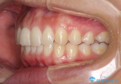 ディープバイトと前歯のデコボコを治したい インビザラインによる矯正治療の治療中