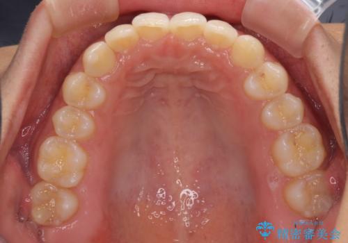 ディープバイトと前歯のデコボコを治したい インビザラインによる矯正治療の治療中