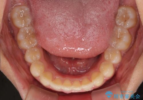 ディープバイトと前歯のデコボコを治したい インビザラインによる矯正治療の治療中