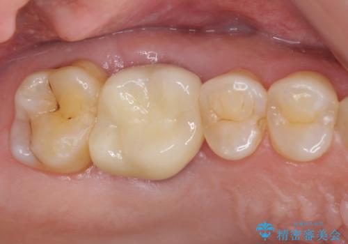 歯周外科処置を併用した奥歯の補綴治療の症例 治療後
