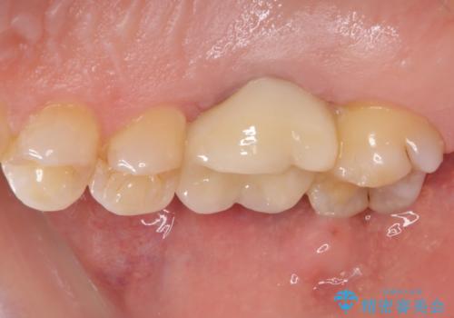 歯周外科処置を併用した奥歯の補綴治療の治療後