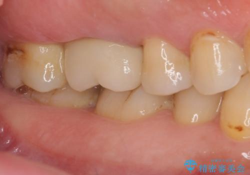 歯周外科処置を併用した奥歯の補綴治療の治療後
