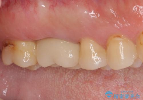 歯周外科処置を併用した奥歯の補綴治療の治療後