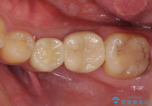 セラミッククラウンによる奥歯のむし歯治療の症例 治療後