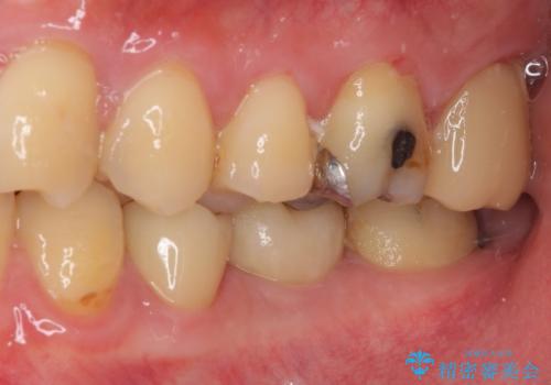 セラミッククラウンによる奥歯のむし歯治療の治療後