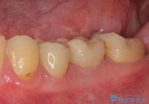 セラミッククラウンによる奥歯のむし歯治療の治療後