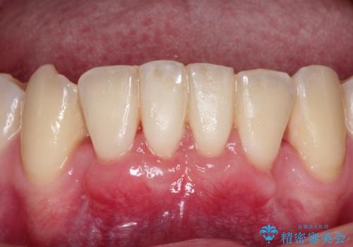 下顎前歯の歯肉退縮　結合組織を用いた根面被覆の治療後