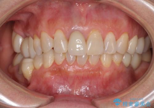 金属を全てセラミックに メタルフリー治療の治療後