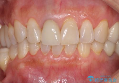 金属を全てセラミックに メタルフリー治療の治療後