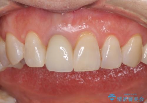 金属を全てセラミックに メタルフリー治療の治療後
