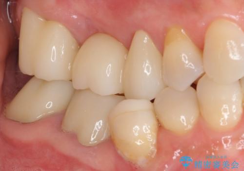 金属を全てセラミックに メタルフリー治療の治療後